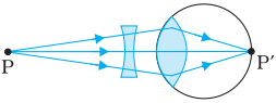 Corrected myopic eye